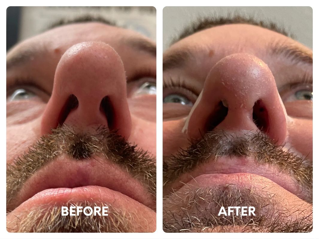 40 year old male_ revision rhinoplasty (2)