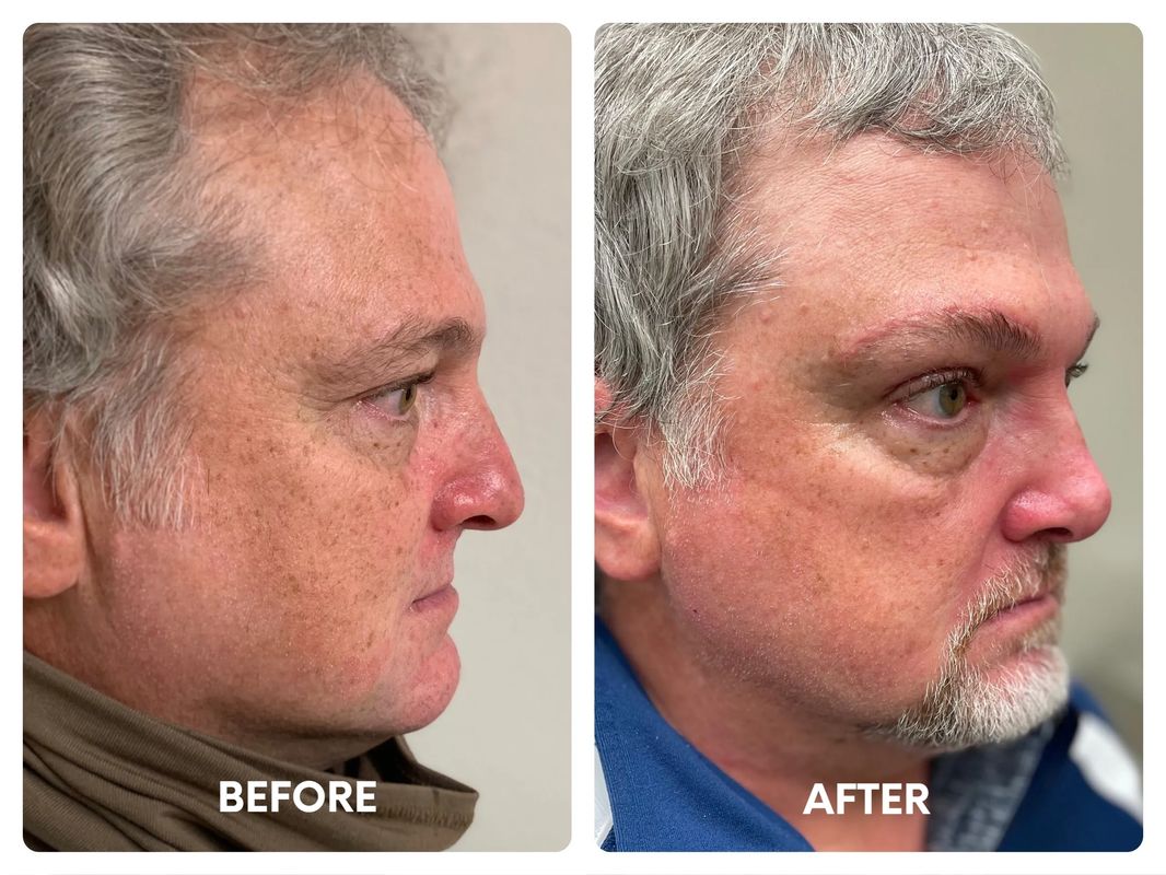 48 year old male_ functional rhinoplasty for nasal_ (1)
