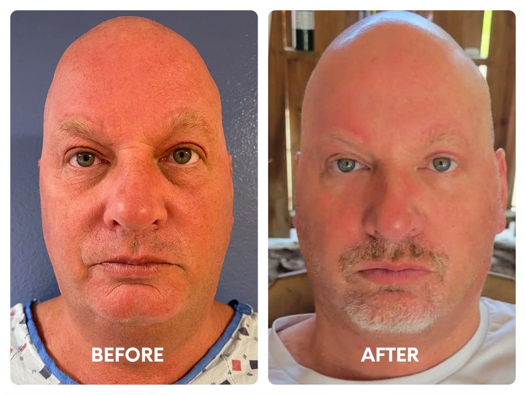 50 year old male lower facelift_ revision upper_yyt (1)