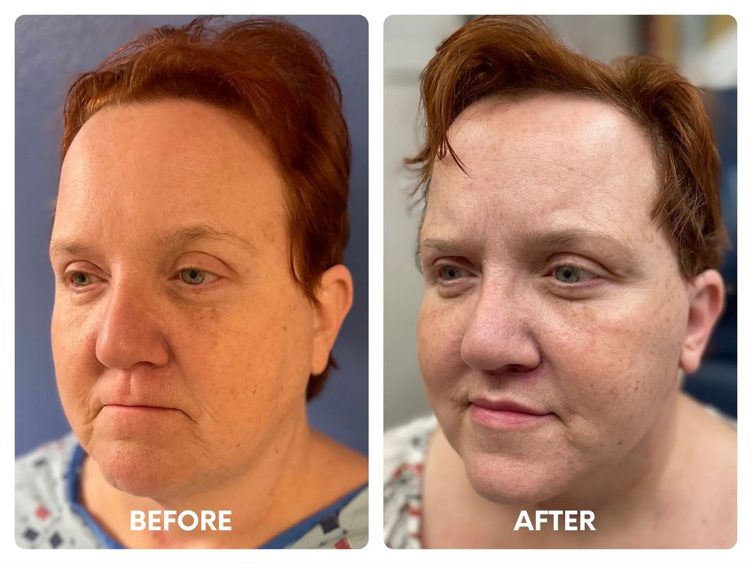 54 year old female facelift_ lip lift_ fat t (1)