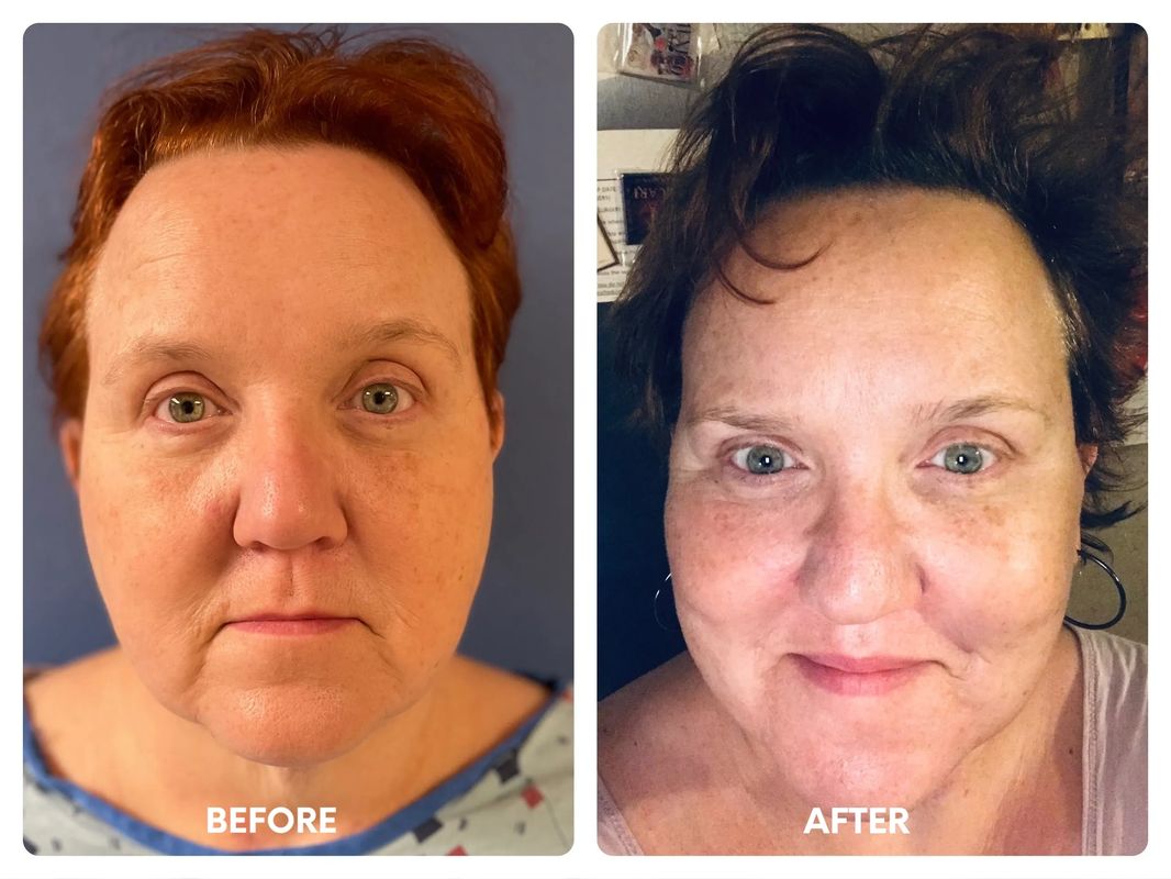 54 year old female facelift_ lip lift_ fat t (2)