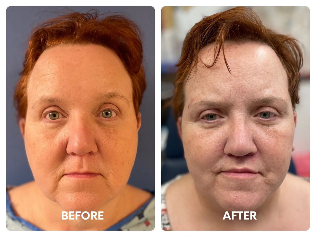 54 year old female facelift_ lip lift_ fat t