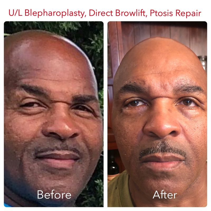 62 year old male_ 4 quad blepharoplasty and