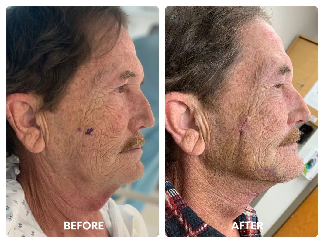 67 year old male_ direct necklift (2)