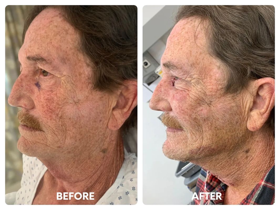67 year old male_ direct necklift (3)