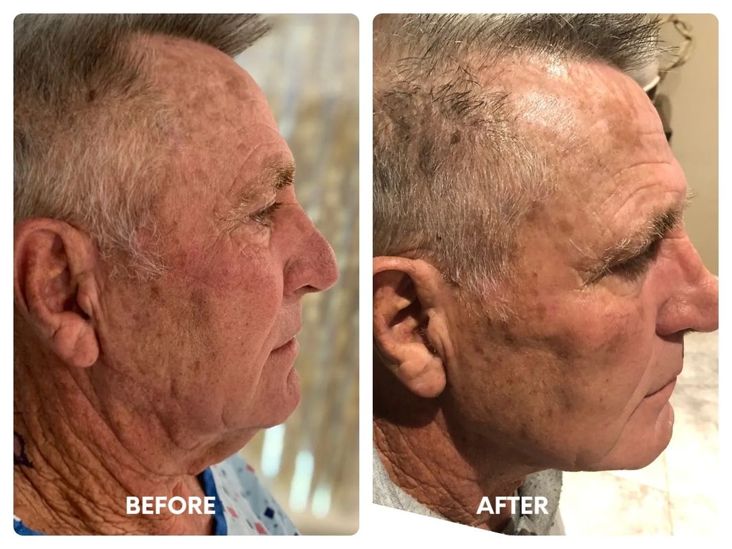 68 year old male direct necklift (1)