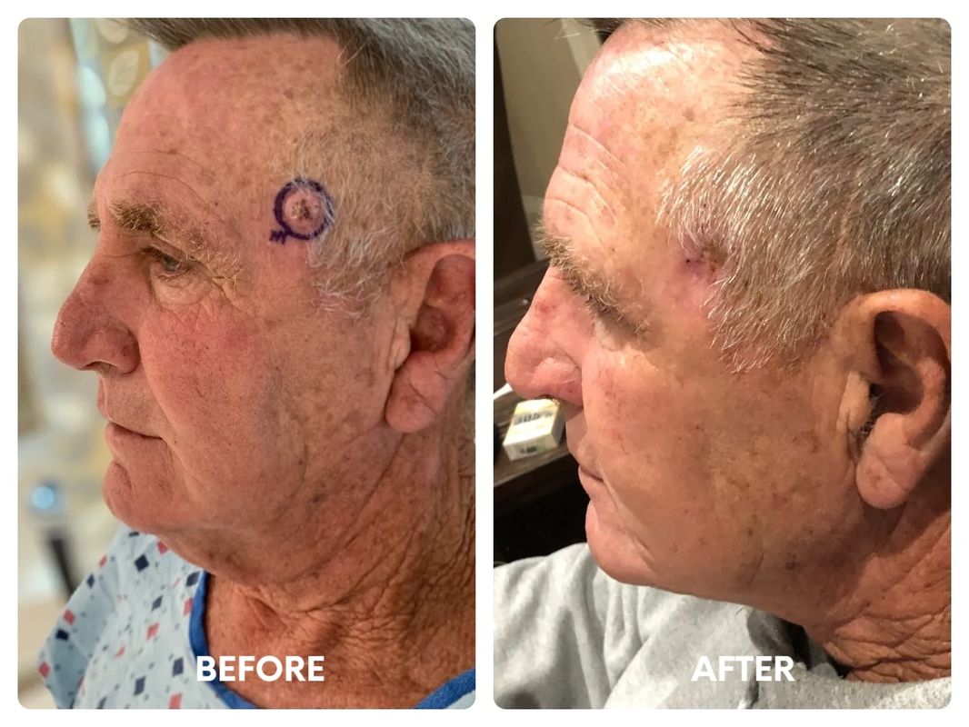 68 year old male direct necklift (2)