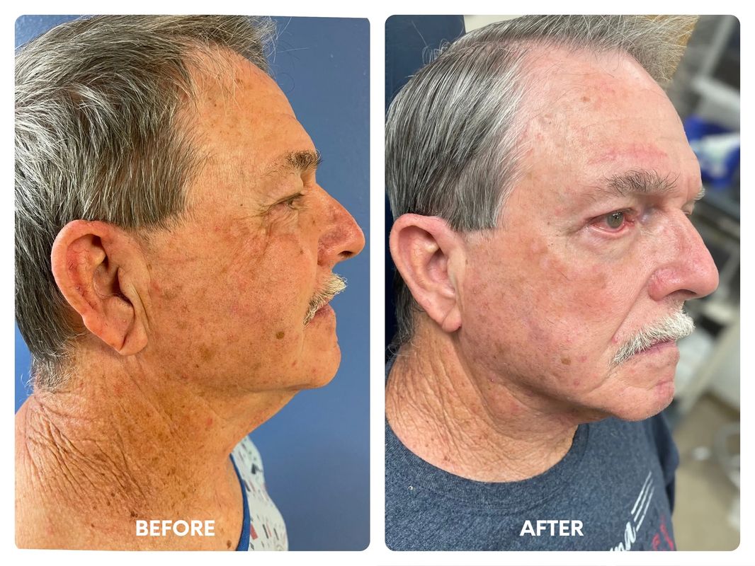 70 year old male minimal access necklift with_yythk