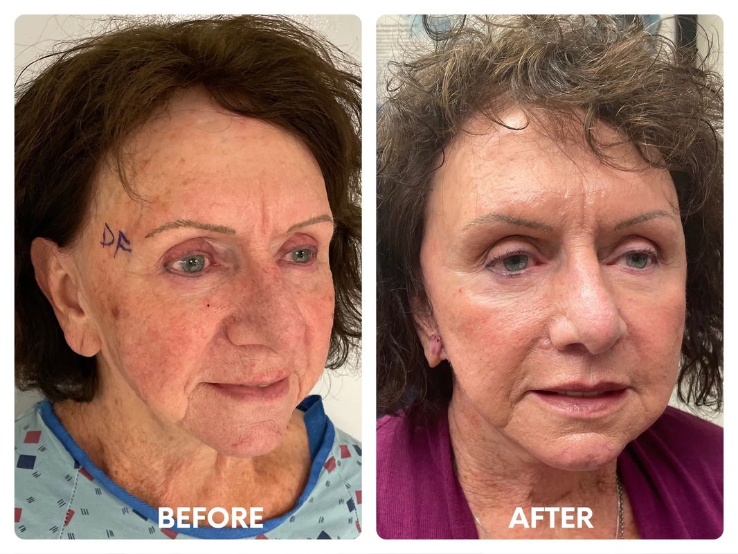71 year old female facelift_ browlift_ eyelid lifts (1)