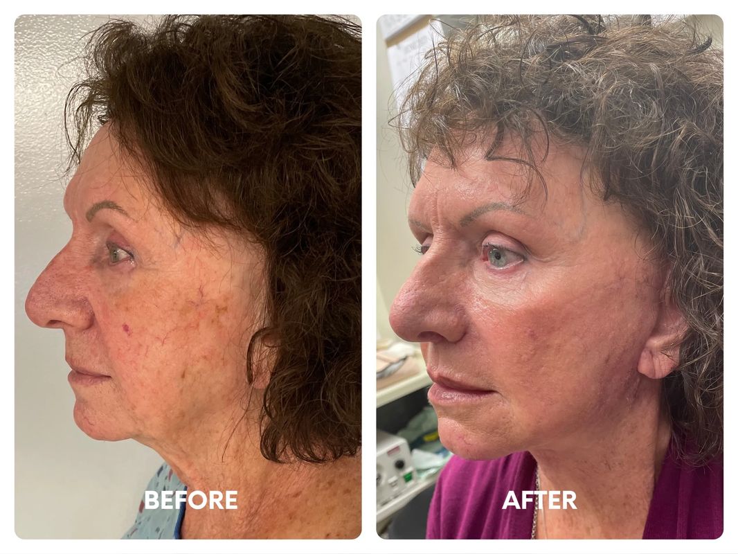 71 year old female facelift_ browlift_ eyelid lifts