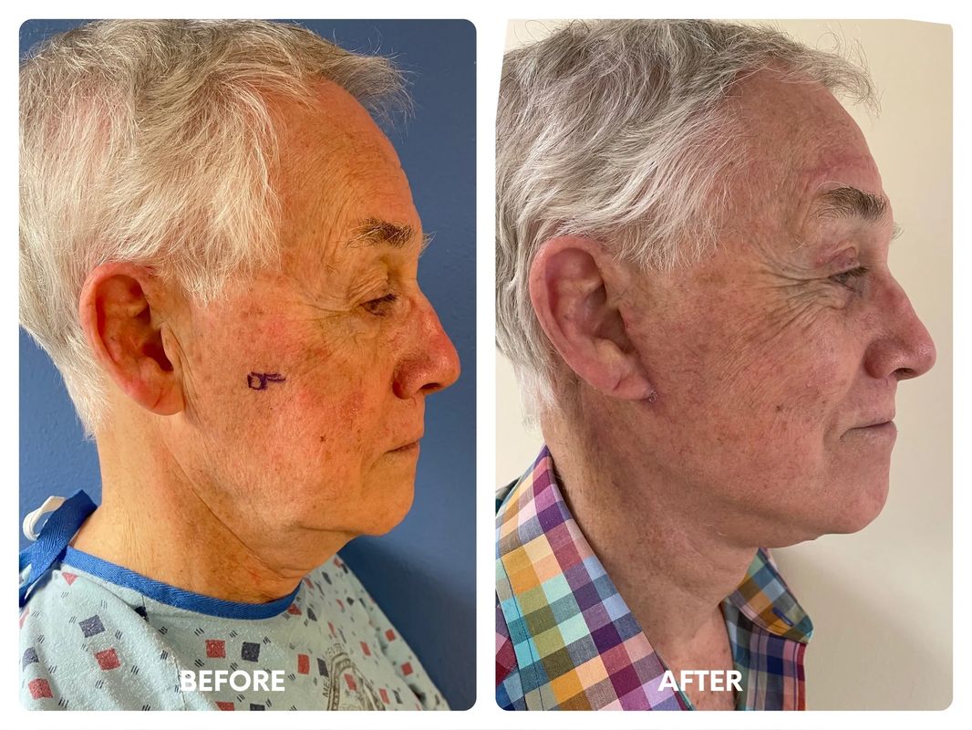 76 year old male lower facelift_ browlift_ eyelid_y (1)