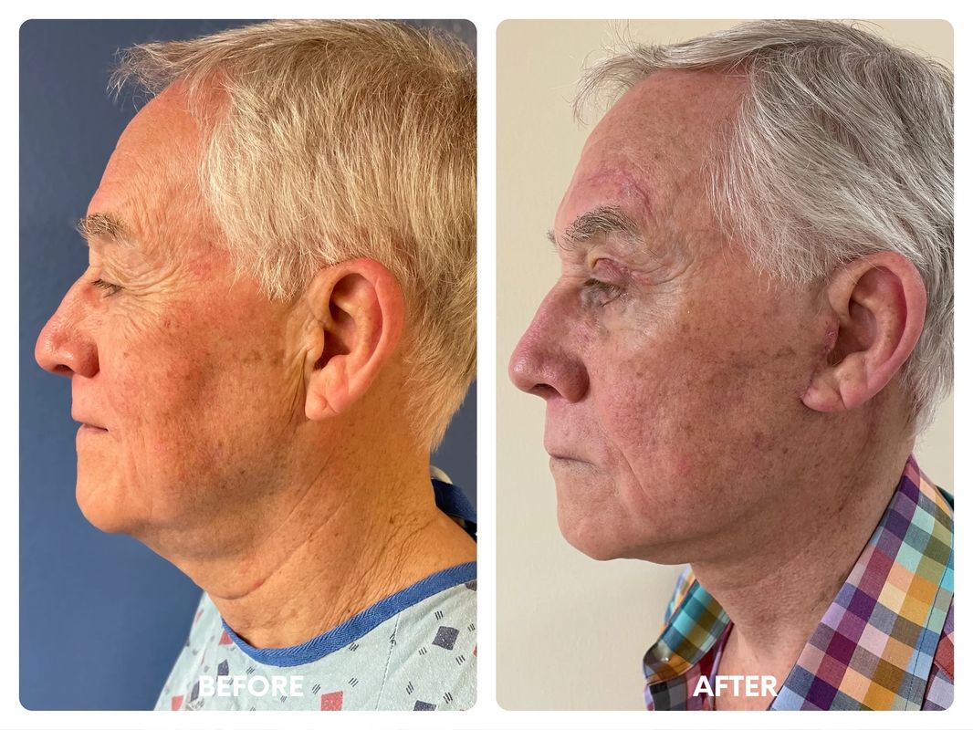 76 year old male lower facelift_ browlift_ eyelid_y