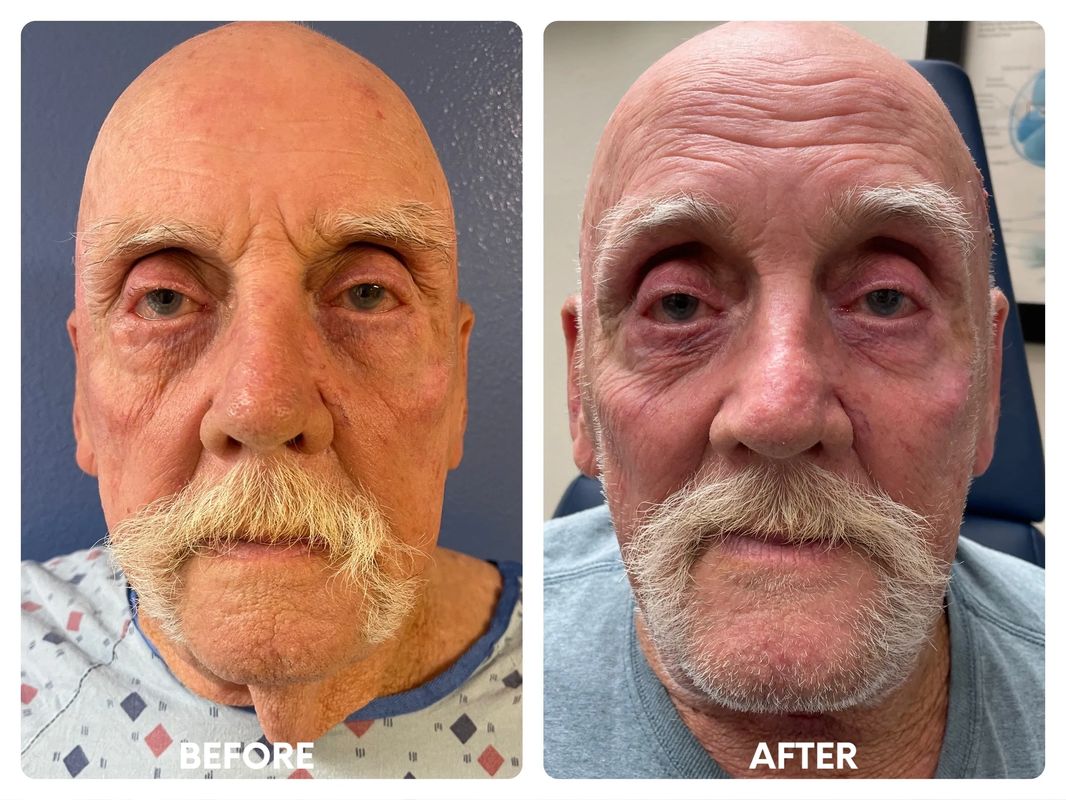 78 year old male_ direct necklift