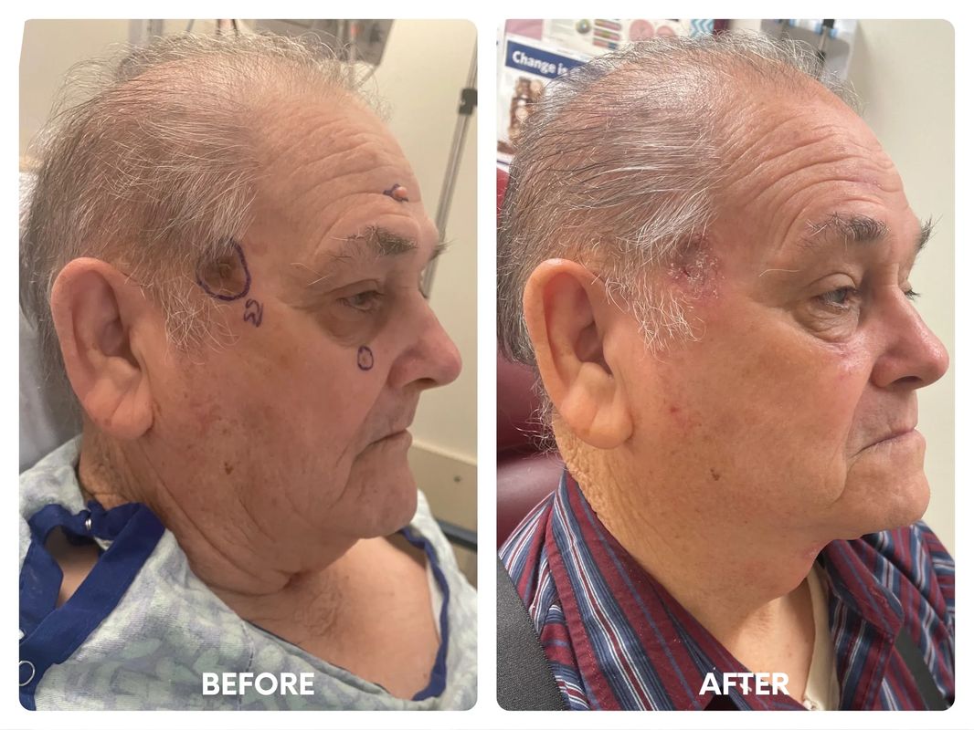 79 year old male_ direct necklift (1)