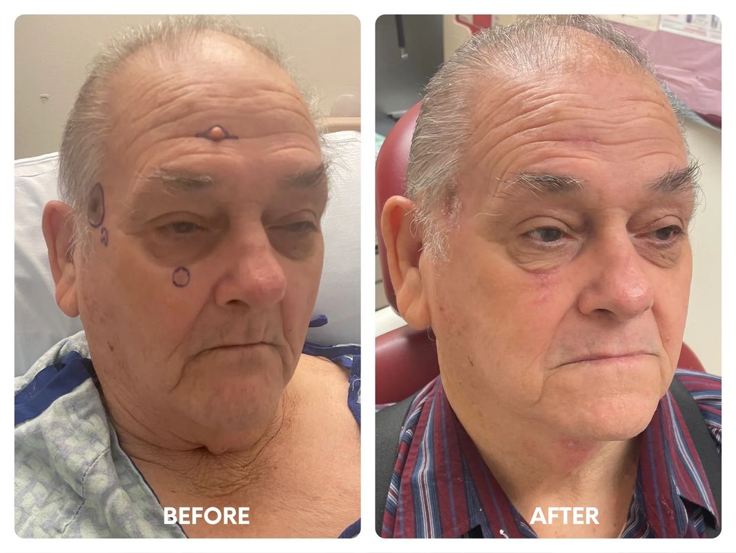 79 year old male_ direct necklift (2)