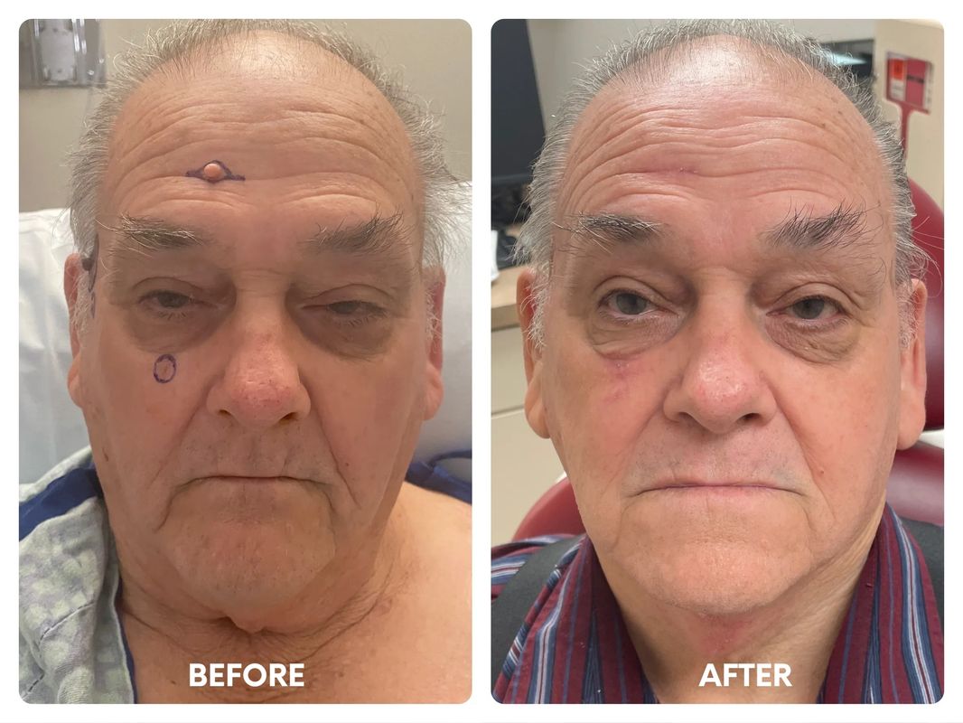 79 year old male_ direct necklift