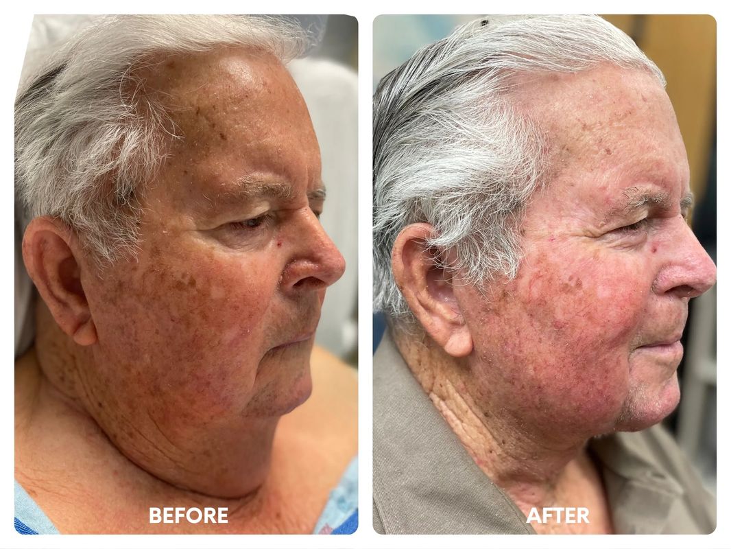 81 year old male necklift (1)