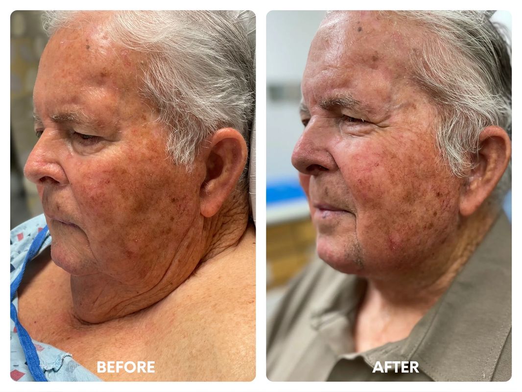 81 year old male necklift