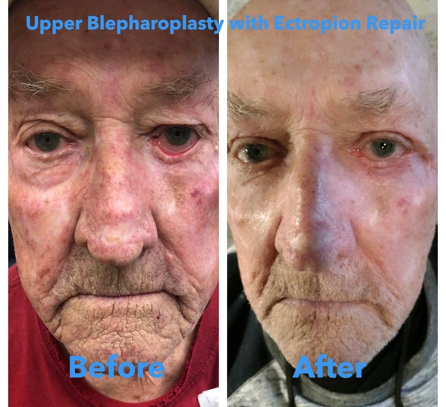 82 year old male upper eyelid lift and cicat