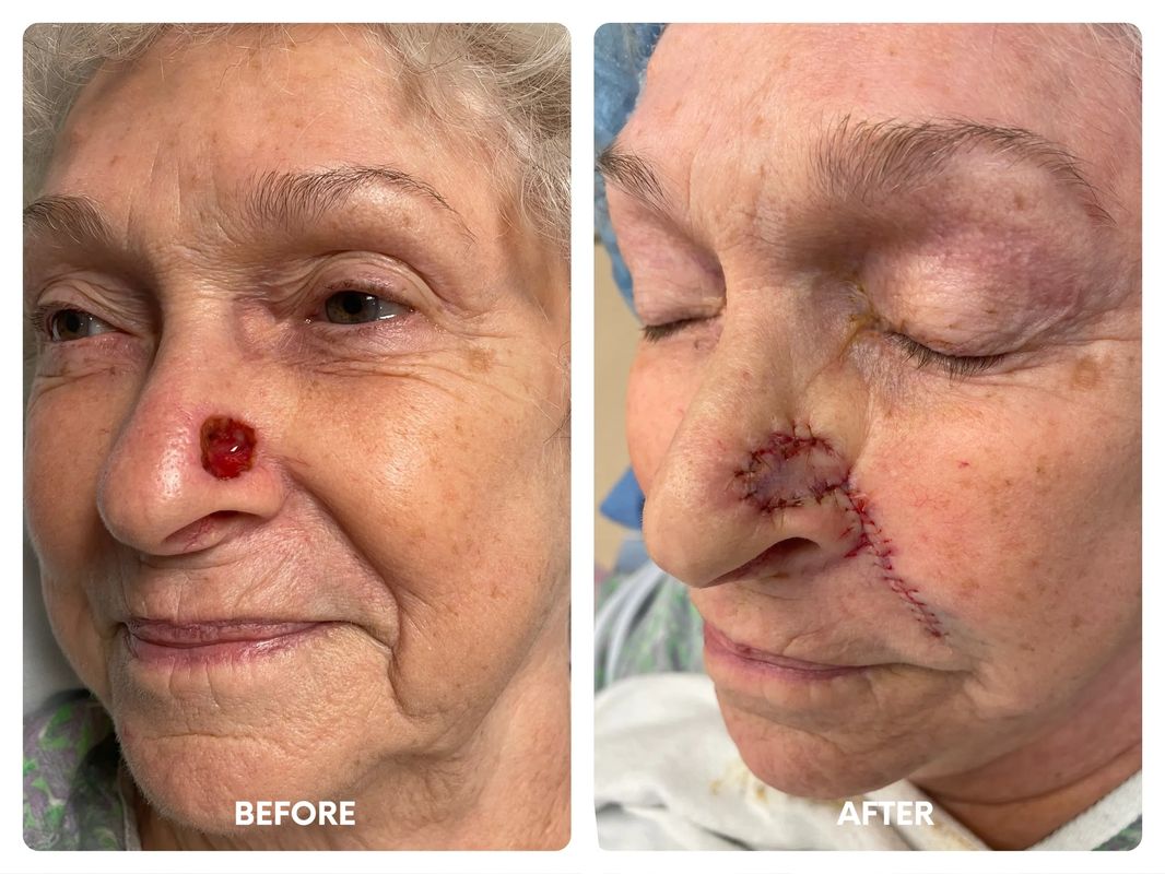 84 year old female_ reconstruction left nostril