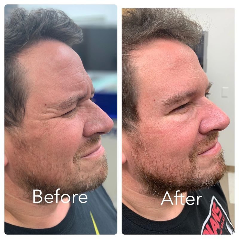 Full face male rejuvenation with Botox and tear_yyt