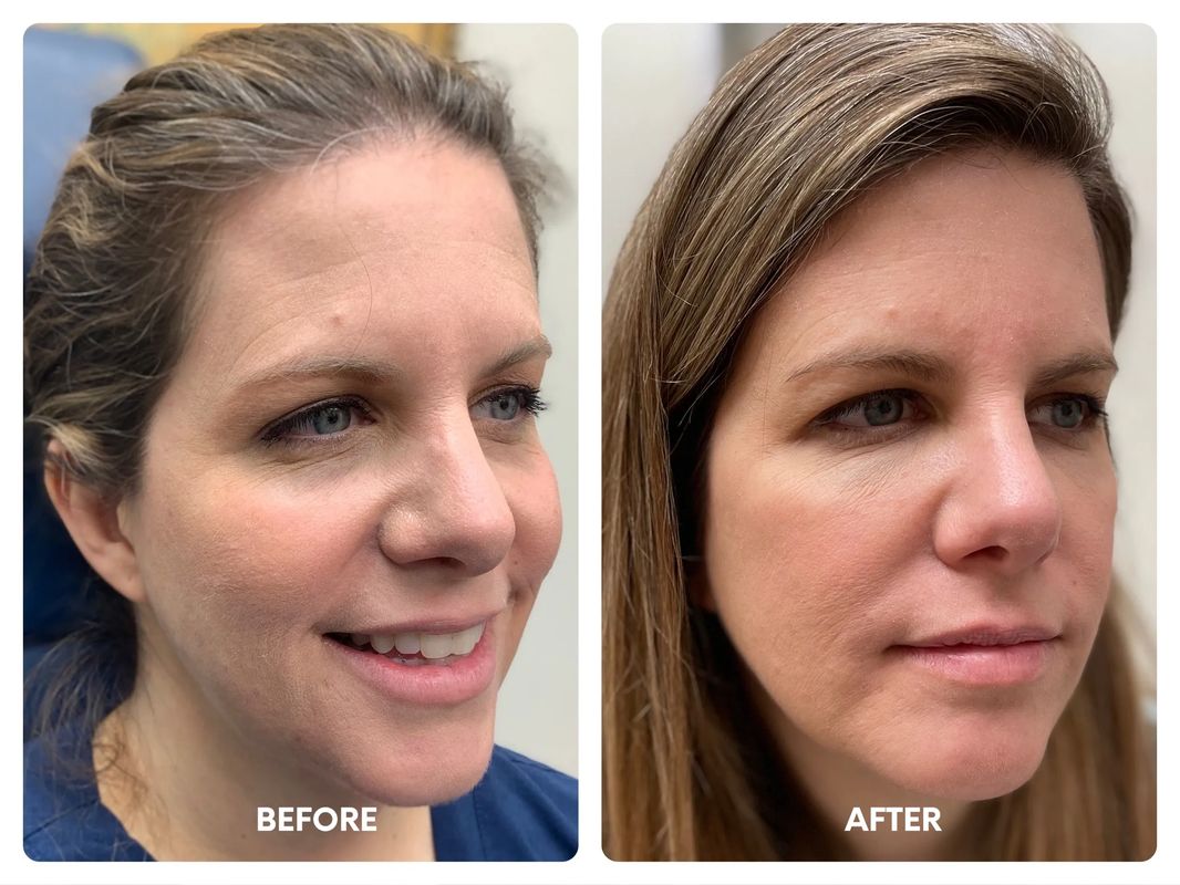 Full face rejuvenation with dermal fillers