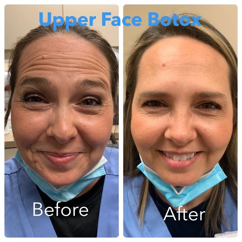 Full facial rejuvenation with Botox (7)