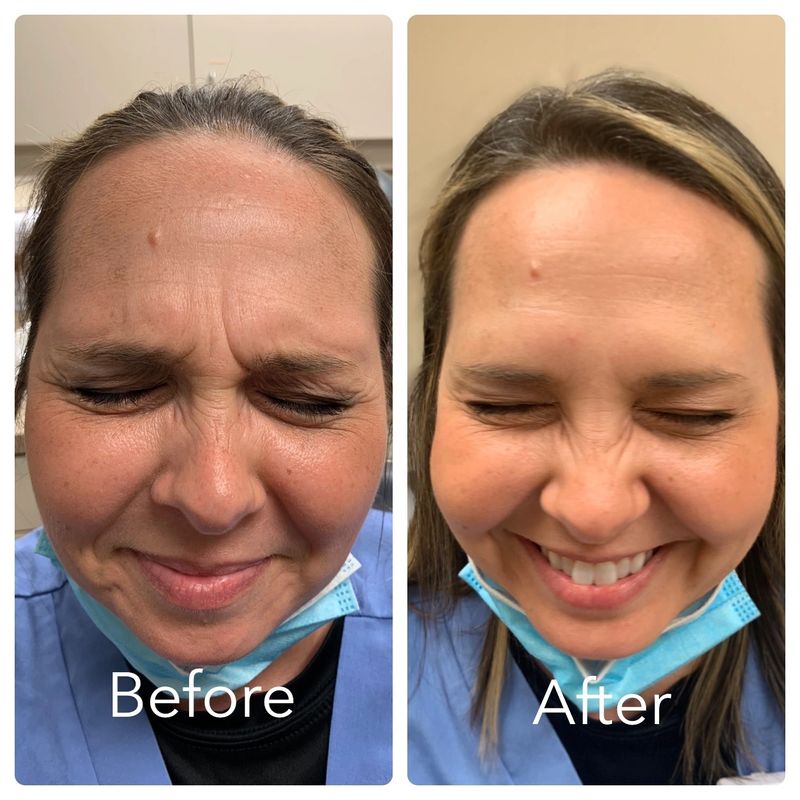 Full facial rejuvenation with Botox (9)