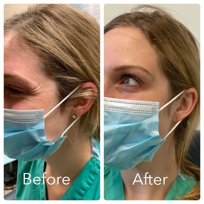 Upper face rejuvenation in a young female with_yyth