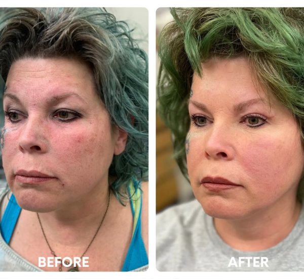 50 year old female_ cheek contouring with buccal_yy (1)