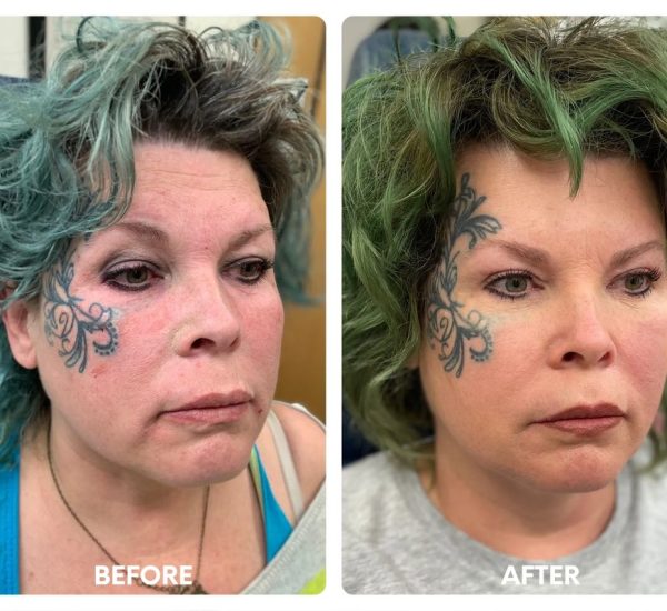 50 year old female_ cheek contouring with buccal_yy