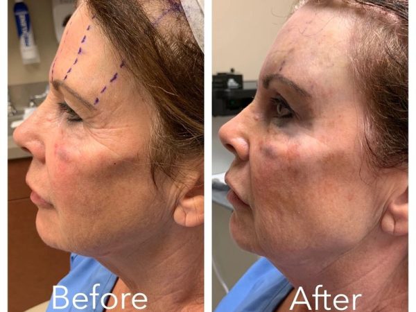 60 year old female_ in-office temporal browlift (2)