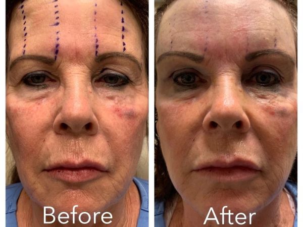 60 year old female_ in-office temporal browlift (3)