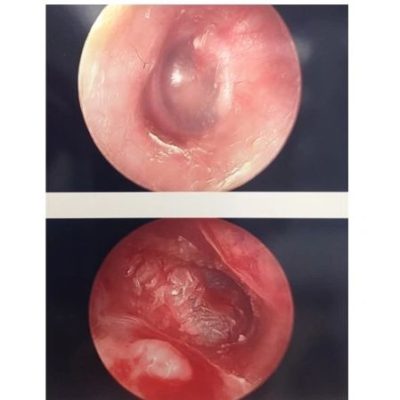 Normal eardrum and Infection eardrum
