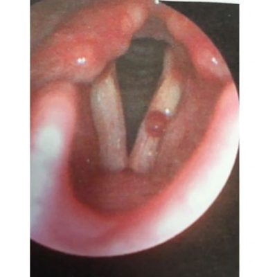 Vocal cord lesion