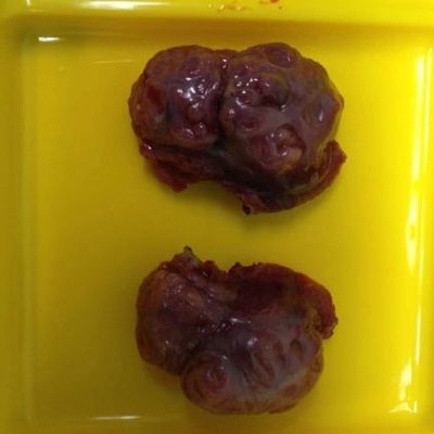 Diseased Tonsils- tonsillectomy